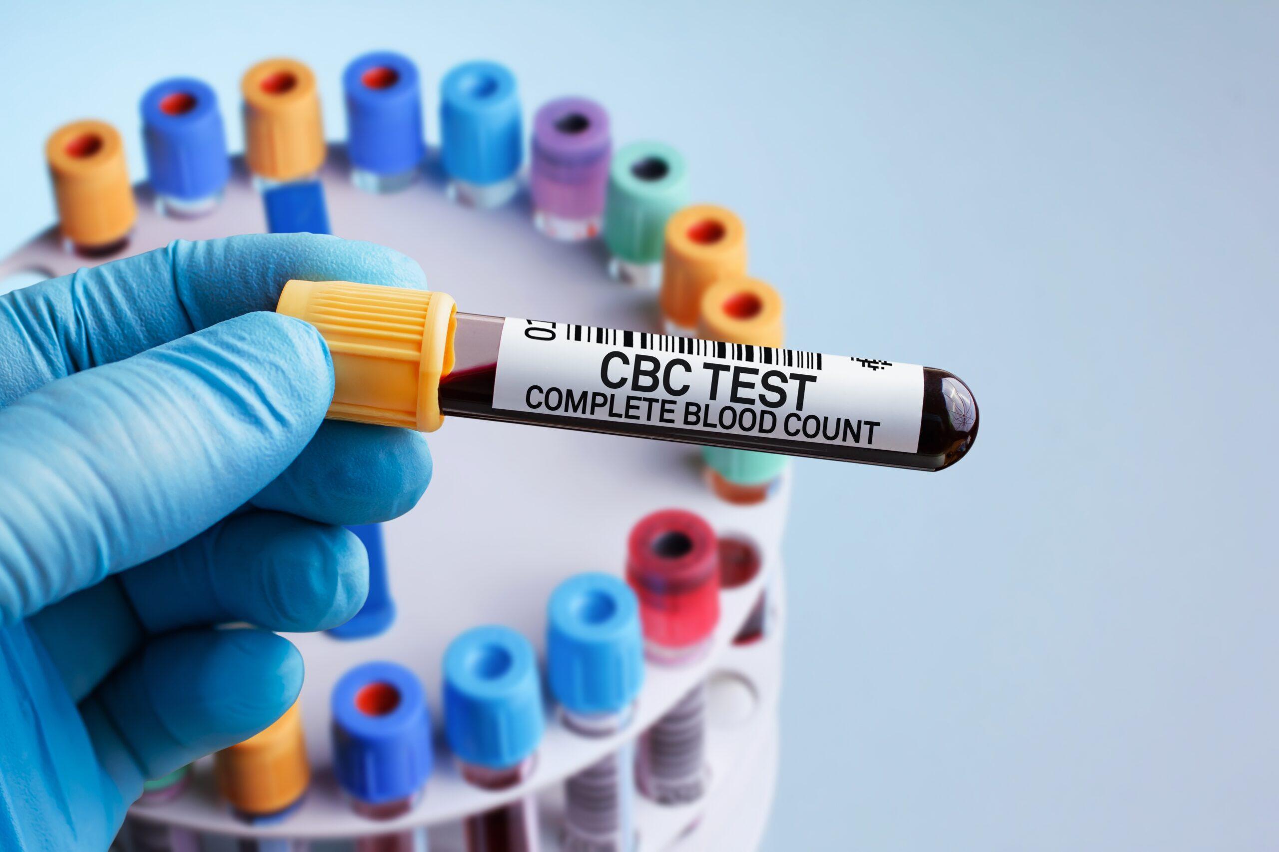 CBC (Complete Blood Count) Test shree laboratory jamnagar