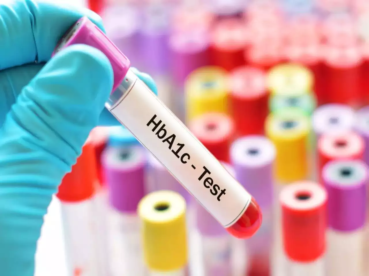 HbA1C Test or Glycated Haemoglobin Test shree laboratory jamnagar