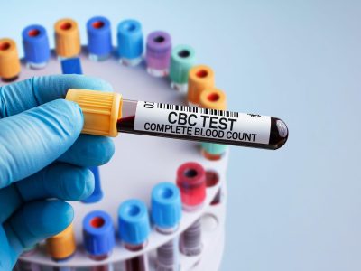 CBC (Complete Blood Count) Test shree laboratory jamnagar
